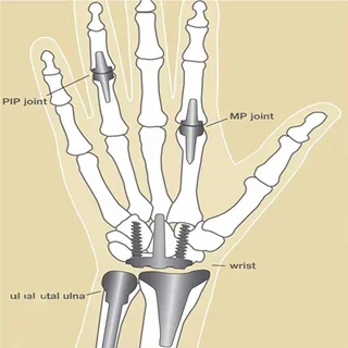 طرح توجیهی تولید پیچ و مهره‌های داخل استخوان مفصل‌های مصنوعی