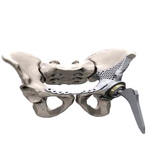 طرح توجیهی تولید پیچ و مهره‌های داخل استخوان مفصل‌های مصنوعی